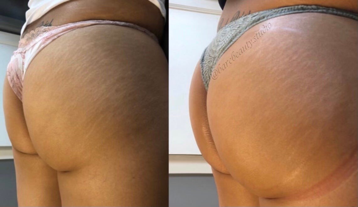 What is non-invasive body contouring? Bare Beauty Spatique